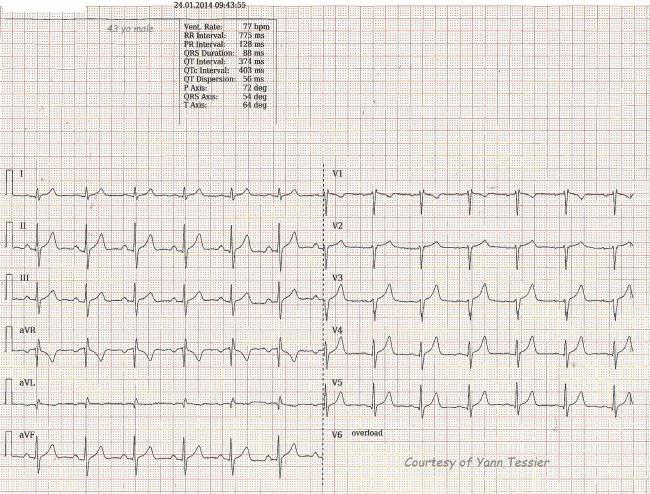 The 12 Lead Ecg Shows A Typical Atrial Flutter With Regular And Images 